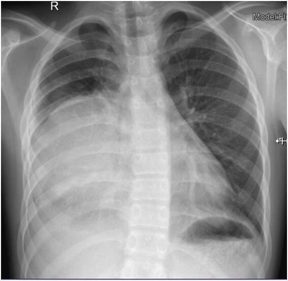 First chest radiograph which reveals a round area of consolidative opacity in the right hemithorax and a pleural effusion.